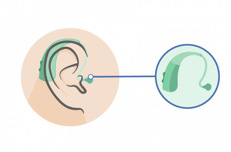 Types of Hearing Aids Explained